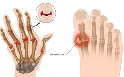 Bác sĩ phân tích nước giải ion kiềm giúp giảm biến chứng bệnh gout