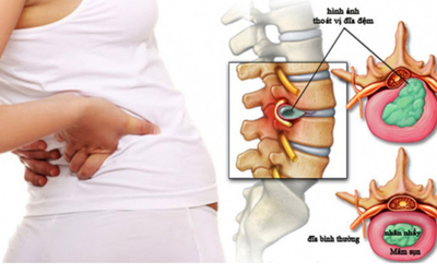 Bị thoát vị đĩa đệm cổ - Đừng lo đã có Cốt Thoái Vương?