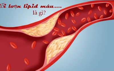 Tại sao Lipidcleanz là công thức độc đáo cho người rối loạn lipid máu?