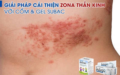 Giải pháp cải thiện zona thần kinh hiệu quả với cốm & gel Subạc