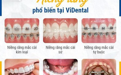 Niềng Răng Trả Góp Lãi Suất 0% tại ViDental: Cam Kết Bảo Hành TRỌN ĐỜI