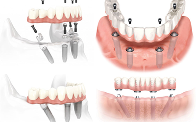 Những điều bạn cần biết về kỹ thuật cấy ghép Implant