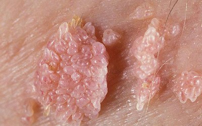 Bé trai 6 tuổi bị sùi mào gà, bố mẹ ngơ ngác nhìn nhau