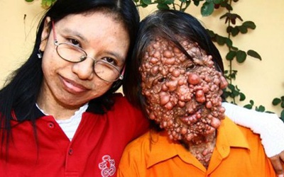 Kỳ lạ người đàn ông mắc bệnh “bong bóng”