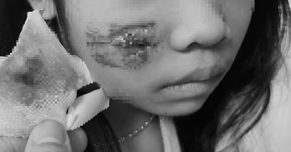 Đang chơi ở sân nhà, bé 8 tuổi bị khỉ tấn công, vết thương phức tạp