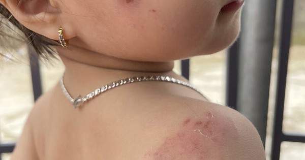 Nhà trường báo cáo gì về vụ bé gái 2 tuổi bị nhiều vết cắn khi học ở lớp?