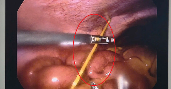 Đau bụng dữ dội, bác sĩ phát hiện thứ 