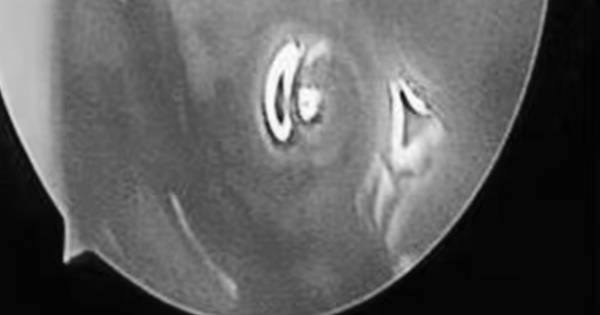 Bé trai hơn 2 tuổi chảy mũi hàng ngày, bác sĩ phát hiện ra 