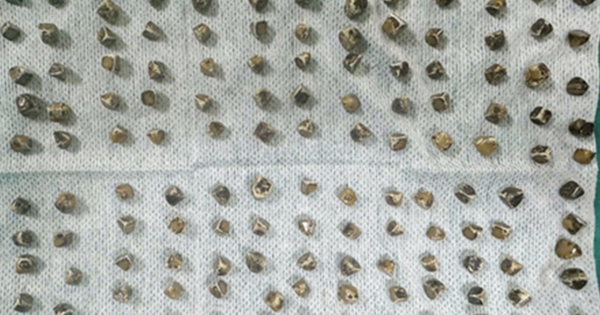 Đau bụng đi khám, người phụ nữ 40 tuổi sốc khi bác sĩ gắp ra thứ 