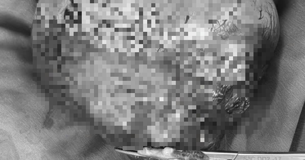 Đi siêu âm, người đàn ông sốc nặng khi thấy vật thể 