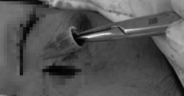 Bé trai đau vùng mắt dữ dội, bác sĩ sốc khi phát hiện dị vật 