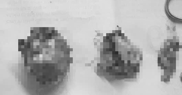 Người phụ nữ 66 tuổi đau bụng kéo dài, bác sĩ gắp ra thứ 