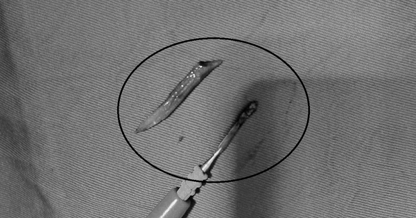 Người đàn ông 41 tuổi đau bụng, bác sĩ sốc phát hiện ra thứ đáng sợ 