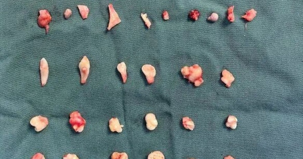 Cô gái đau bụng dữ dội, bác sĩ phát hiện ra bí mật bên trong