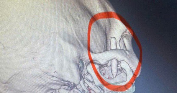 Chàng trai đau thái dương suốt 13 năm, bác sĩ phát hiện ra bí mật 