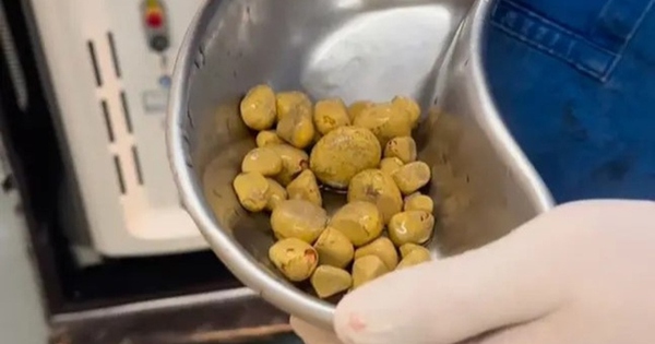 Bác sĩ sốc nặng khi lấy ra thứ đáng sợ trong cơ thể người đàn ông