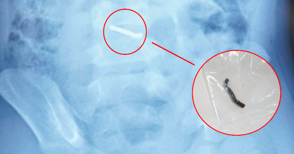 Bé trai 5 tuổi nuốt hàng chục viên nam châm gây thủng ruột