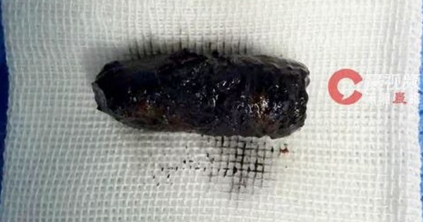 Mũi người đàn ông chảy dịch dai dẳng, bác sĩ phát hiện bí mật đáng sợ