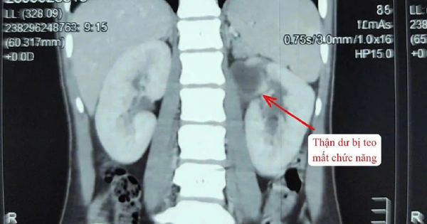 Kỳ lạ cô gái 22 tuổi có 3 quả thận