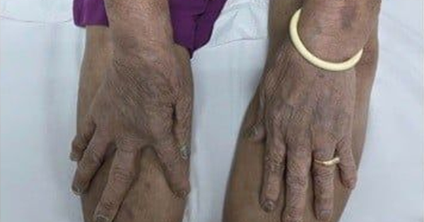 Tin vào thuốc lạ “uống thấy khỏe”, cụ ông 87 tuổi nhập viện trong tình trạng nguy kịch