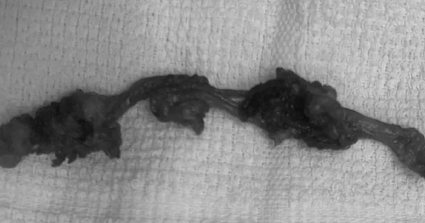 Đau âm ỉ vùng bụng, người đàn ông sốc nặng khi bác sĩ lấy ra thứ 