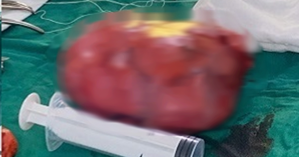 Đau bụng tưởng nhẹ, người phụ nữ sốc nặng khi bác sĩ lấy ra thứ “đáng sợ” trong bụng