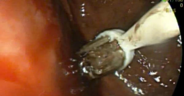 Nam thanh niên 29 tuổi đau bụng, bác sĩ lấy ra thứ 