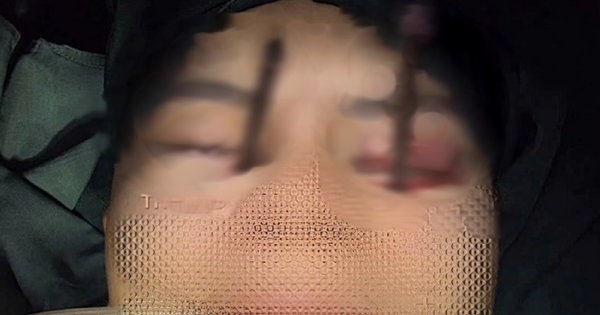 Chàng trai 25 tuổi đau mắt dữ dội, bác sĩ phát hiện bí mật 