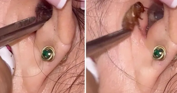 Người phụ nữ đau tai đi khám, bác sĩ gắp ra thứ 