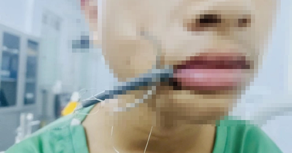 Bé trai 15 tuổi đau dữ dội vùng má, bác sĩ lấy ra thứ 