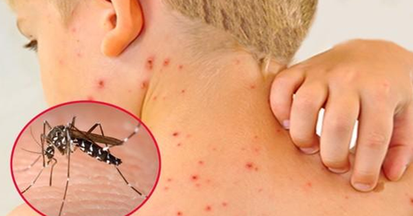 Dịch sốt xuất huyết tăng cao, chuyên gia cảnh báo biến chứng nặng của bệnh