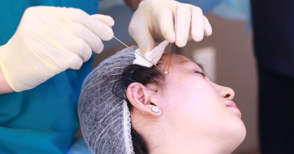 Trào lưu tự căng da mặt tại nhà gây sốc: Nhiều cô gái đối mặt nguy cơ hủy hoại gương mặt