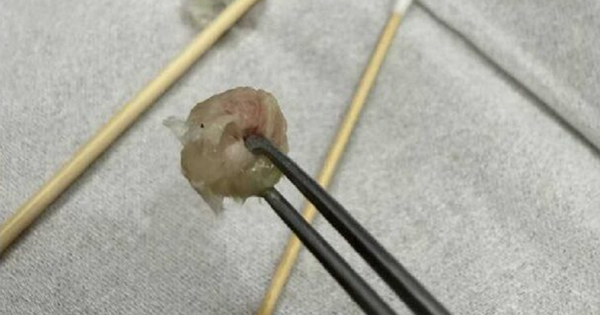 Bé gái 6 tuổi nhập viện khẩn cấp, bố mẹ 